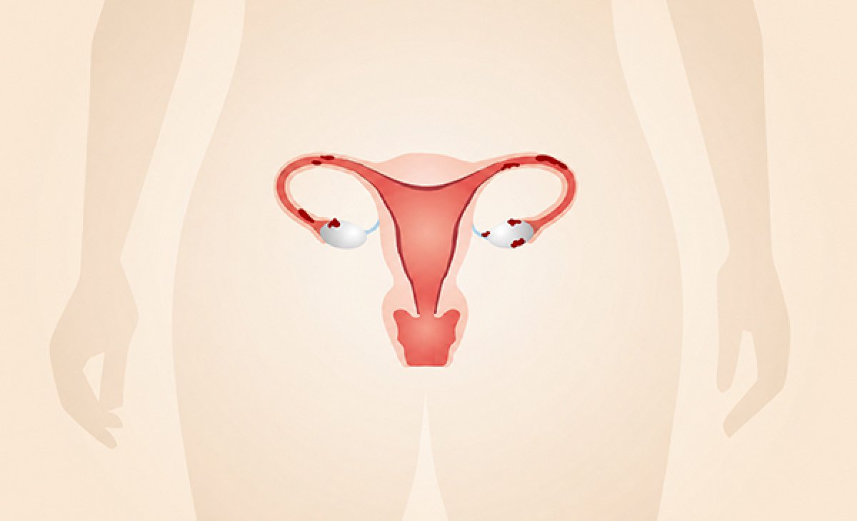 Endometriose Não Tratada Pode Reduzir a Reserva Ovariana?