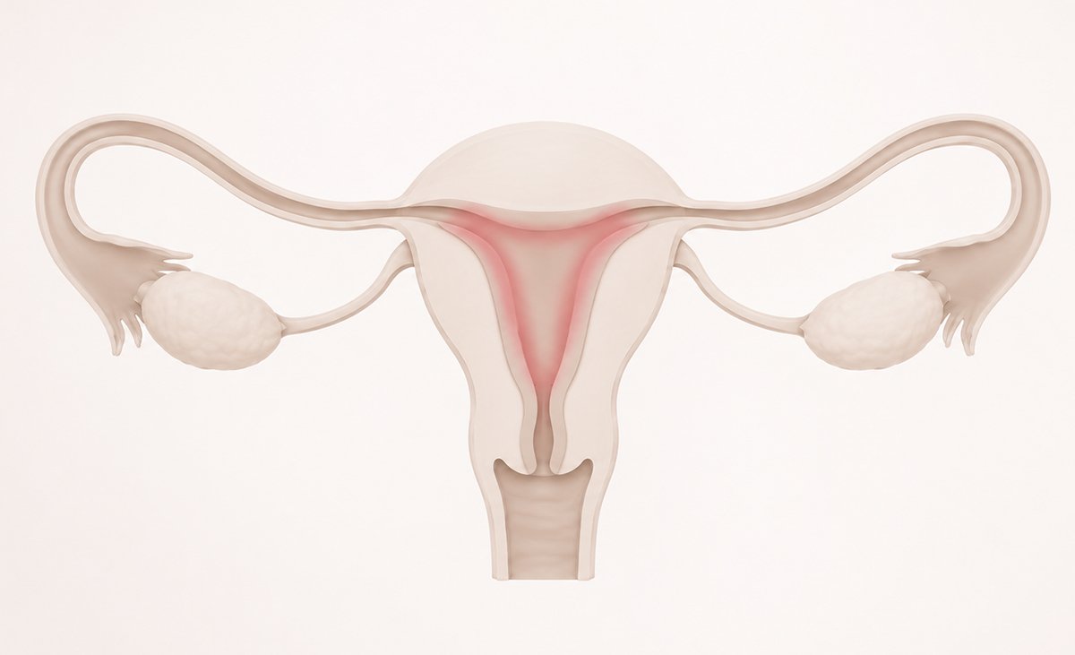 Endometrite Crônica e Falhas na FIV