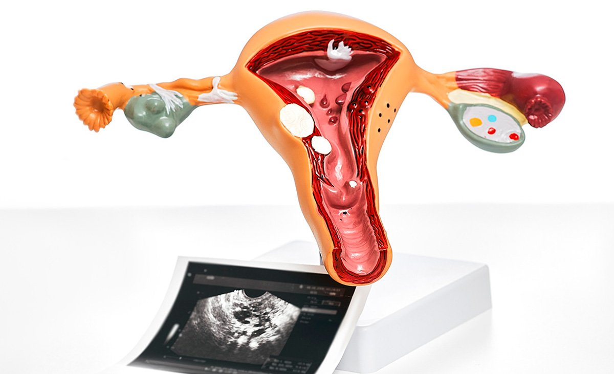 Tratamento Para Miomas Uterinos | Opções Seguras e Eficazes